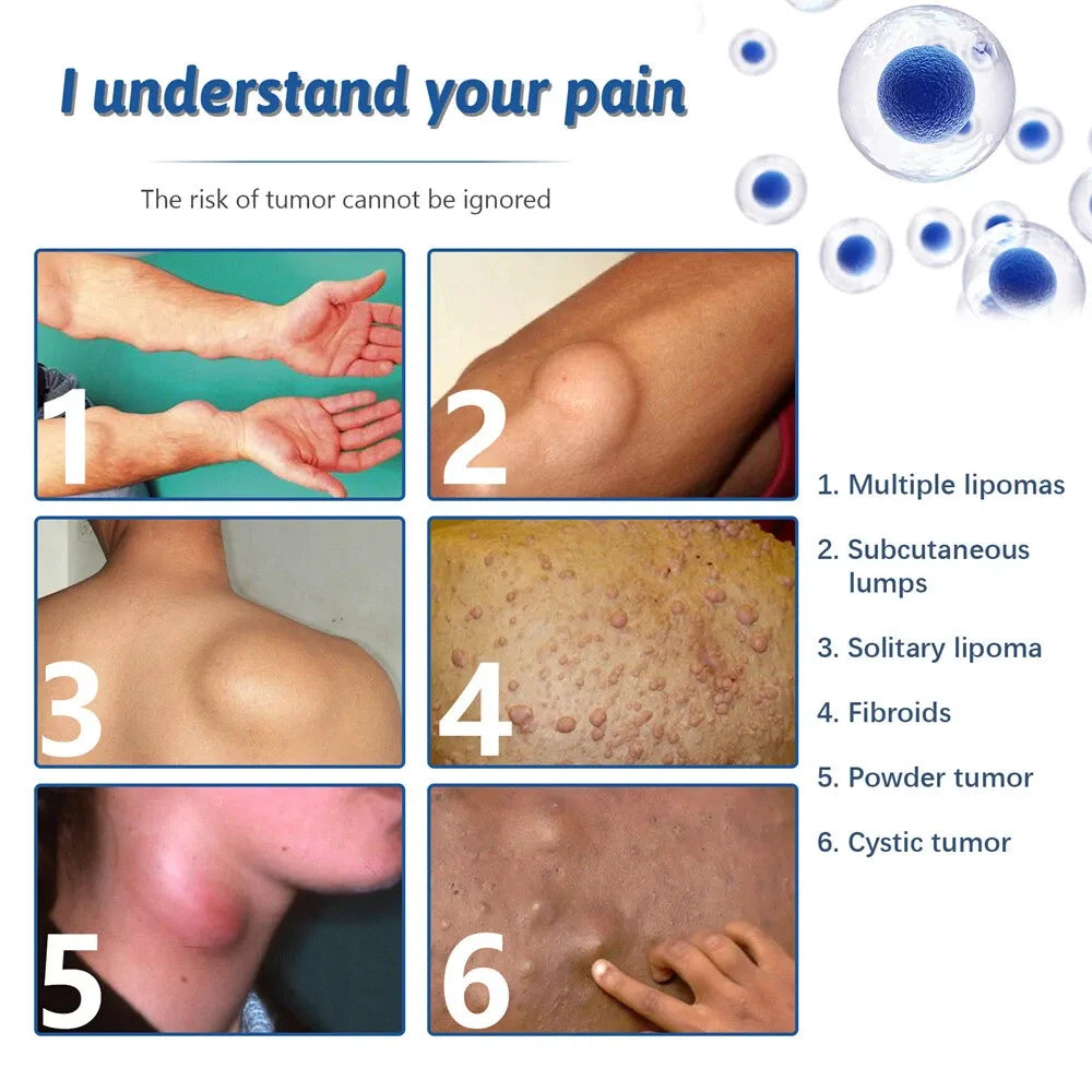 LIPOMA REMOVAL SPRAY (IMPORTED)